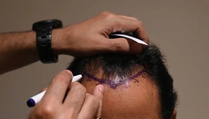 Sapphire Hair Clinic – Your Choice for Hair Transplant Istanbul